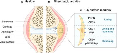 Role and mechanism of fibroblast-activated protein-α expression on the surface of fibroblast-like synoviocytes in rheumatoid arthritis